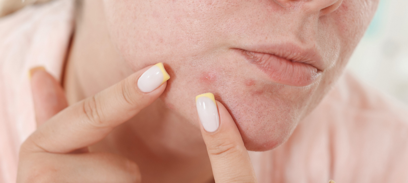 Can Hydrafacial Help with Acne and Scarring?