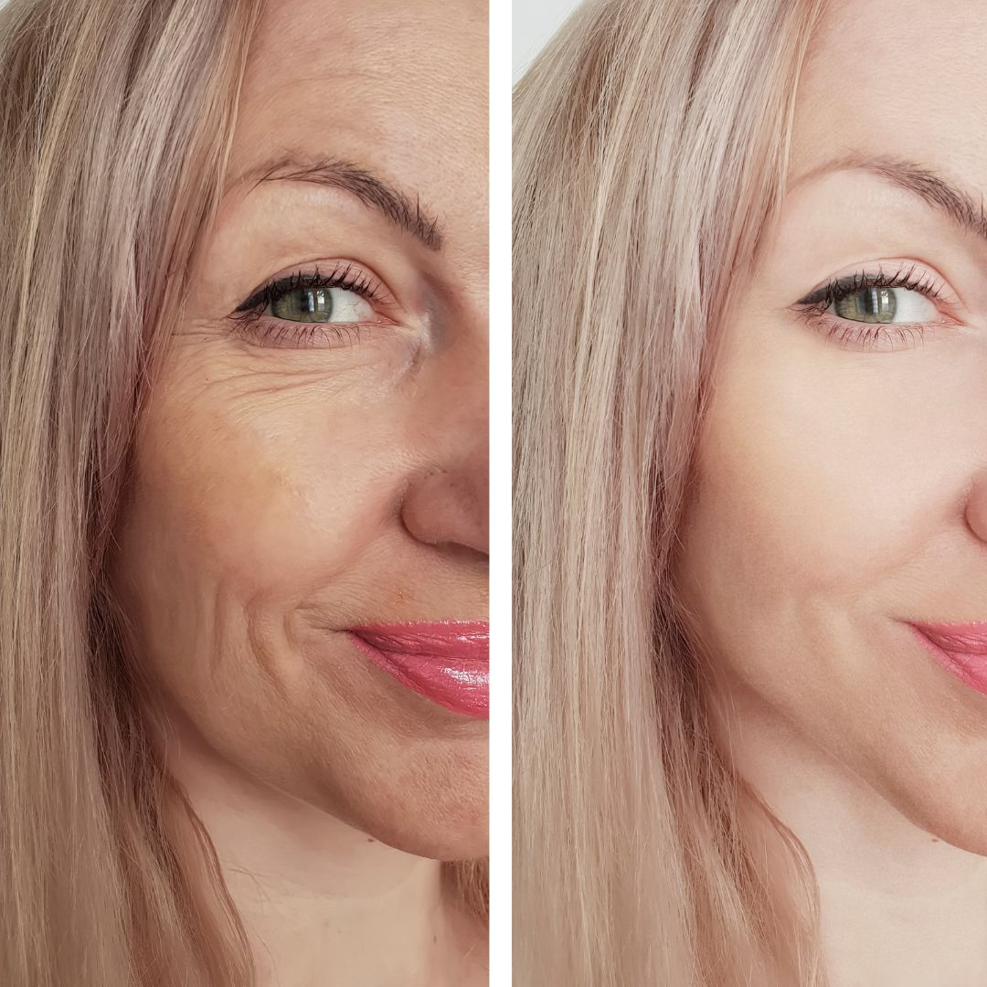 Hydrafacial Before and After: Real Client Results