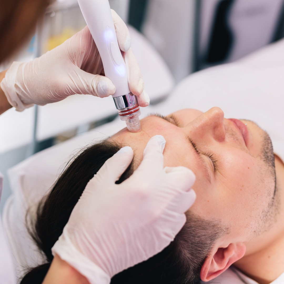 Top 5 Skincare Benefits of Hydrafacial You Didn’t Know About